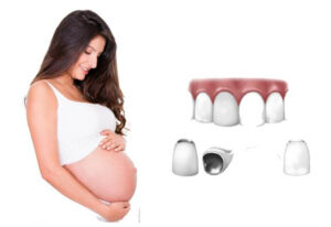 Có nên làm răng sứ khi mang thai không?