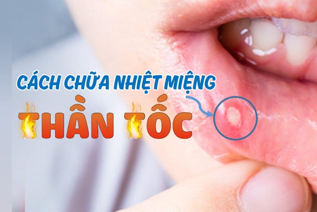 bệnh nhiệt miệng;nguyên nhân bệnh nhiệt miệng;cách điều trị bệnh nhiệt miệng;