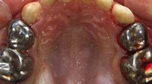 Răng của Bảo Minh sau khi được bọc thép