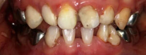 Chủ quan về chăm sóc răng miệng của mẹ cho con nên phải gây mê bọc thép bảo vệ răng