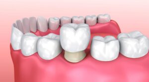 Đối tượng áp dụng bọc răng sứ trả góp