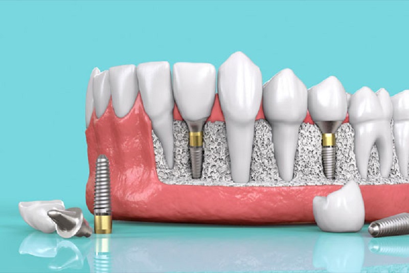 trồng răng implant trả góp