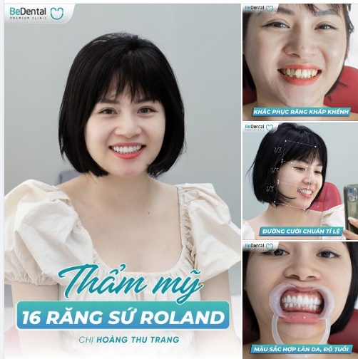 Khách hàng Hoàng Thu Trang làm răng sứ Roland tại nha khoa Bedental