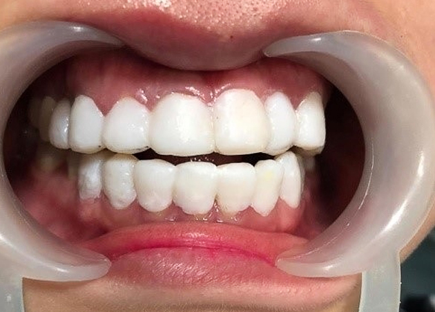 Hệ lụy sau khi làm phủ sứ trắng răng nano
