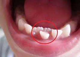 Răng mọc chậm ở trẻ em và những biến chứng nguy hiểm