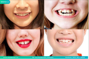 chậm mọc răng ở trẻ có thể gây ra lệch lạc răng gây mất thẩm mỹ