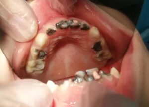 Răng sữa bị sâu gần hết hàm của Tiểu Y