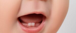 Mọc răng chậm ở trẻ em là hiện tượng ngày càng phổ biến