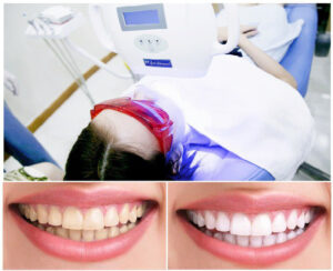 Tẩy trắng răng tại BeDental