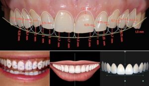 7 yếu tố tạo nên hàm răng sứ đẹp