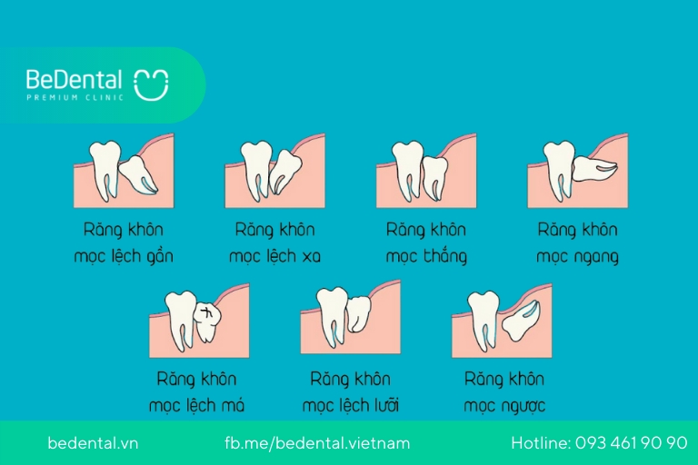 Thế nào là răng khôn mọc lệch? Có nên nhổ răng khôn mọc lệch?