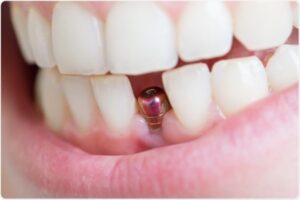 trồng răng implant trả góp đơn giản tại nha khoa bedental