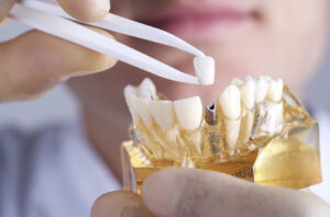trồng răng implant trả góp
