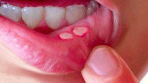 súc miệng bằng nước muối sinh lí giúp giảm viêm lợi và hôi miệng