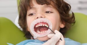 Phòng ngừa sâu răng bằng Vecni fluor an toàn cho trẻ