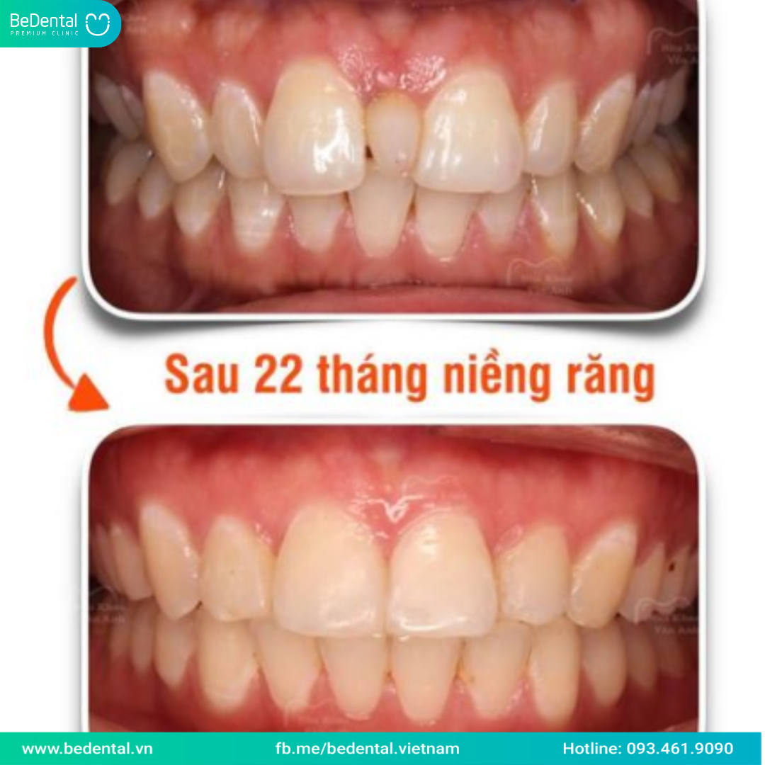 RĂNG KẸ THỪA NÊN NIỀNG HAY BỌC SỨ? 1 SỐ GIẢI PHÁP XỬ LÝ RĂNG KẸ THỪA ...