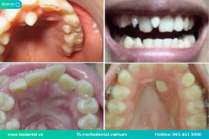 Răng kẹ thừa là răng gì?