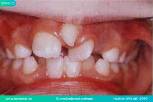 răng kẹ thừa cũng có thể gặp ở trẻ em