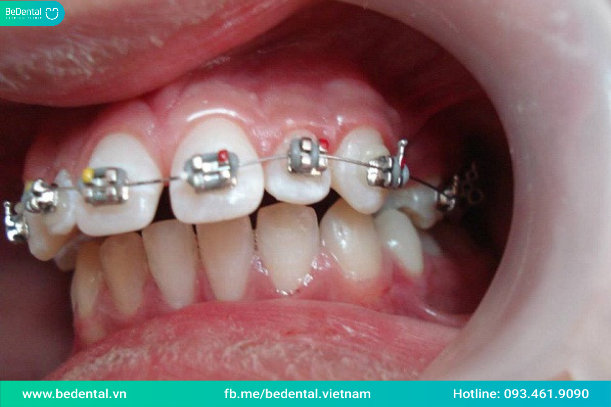 RĂNG KẸ THỪA NÊN NIỀNG HAY BỌC SỨ? 1 SỐ GIẢI PHÁP XỬ LÝ RĂNG KẸ THỪA ...