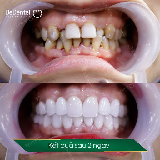 Răng được cải thiện hoàn toàn sau khi bọc răng sứ