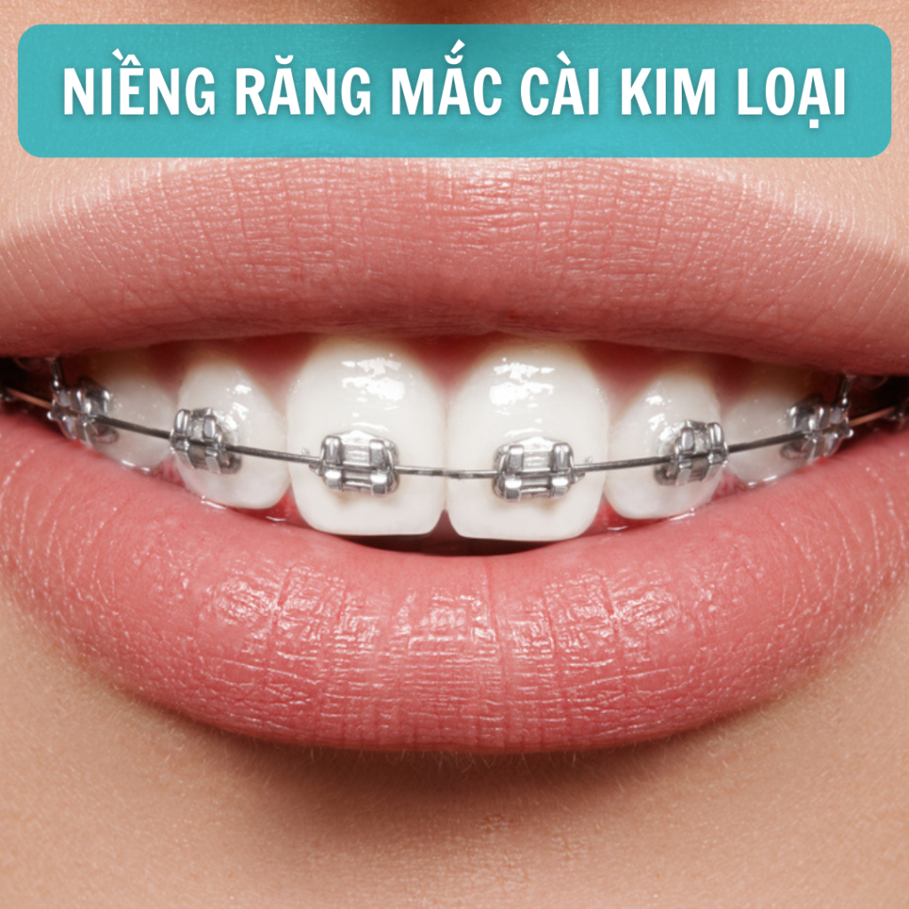 niềng răng mắc cài kim loại
