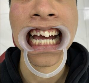 khách hàng bị tai nạn muốn làm bọc răng sứ toàn hàm