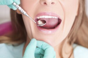 DẤU HIỆU NHẬN BIẾT NHIỄM TRÙNG/KHUẨN RĂNG VÀ CÁCH ĐIỀU TRỊ 6 20191127 050406 784100 benh rang mieng o n.max 1800x1800 1