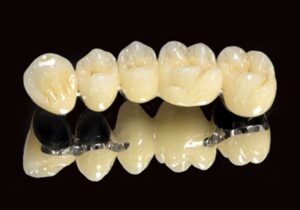 răng sứ kim loại titan