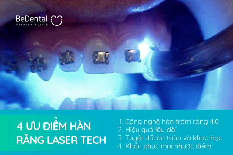4 ưu điểm nổi bật của Laser Tech