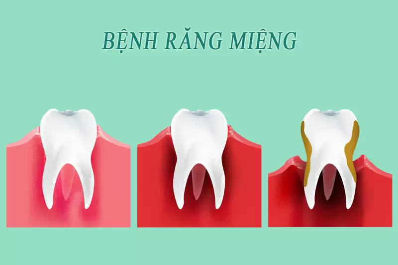 bệnh lý răng miệng thường gặp; bệnh lý răng miệng; các bệnh lý răng miệng thường gặp; điều trị các bệnh lý răng miệng; điều trị các bệnh lý răng miệng thường gặp;