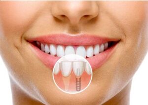 Process of American implant Dentinum