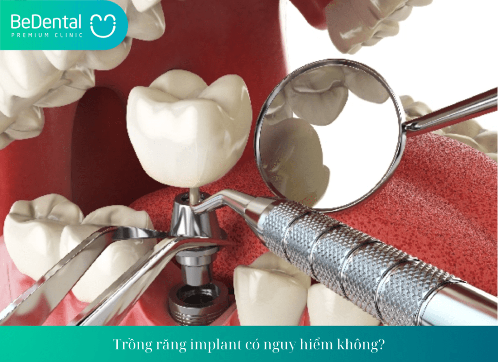 Trồng răng implant có nguy hiểm không?