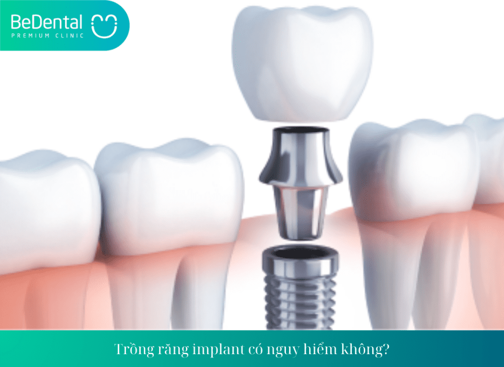 Những biến chứng khi trồng răng implant là gì?