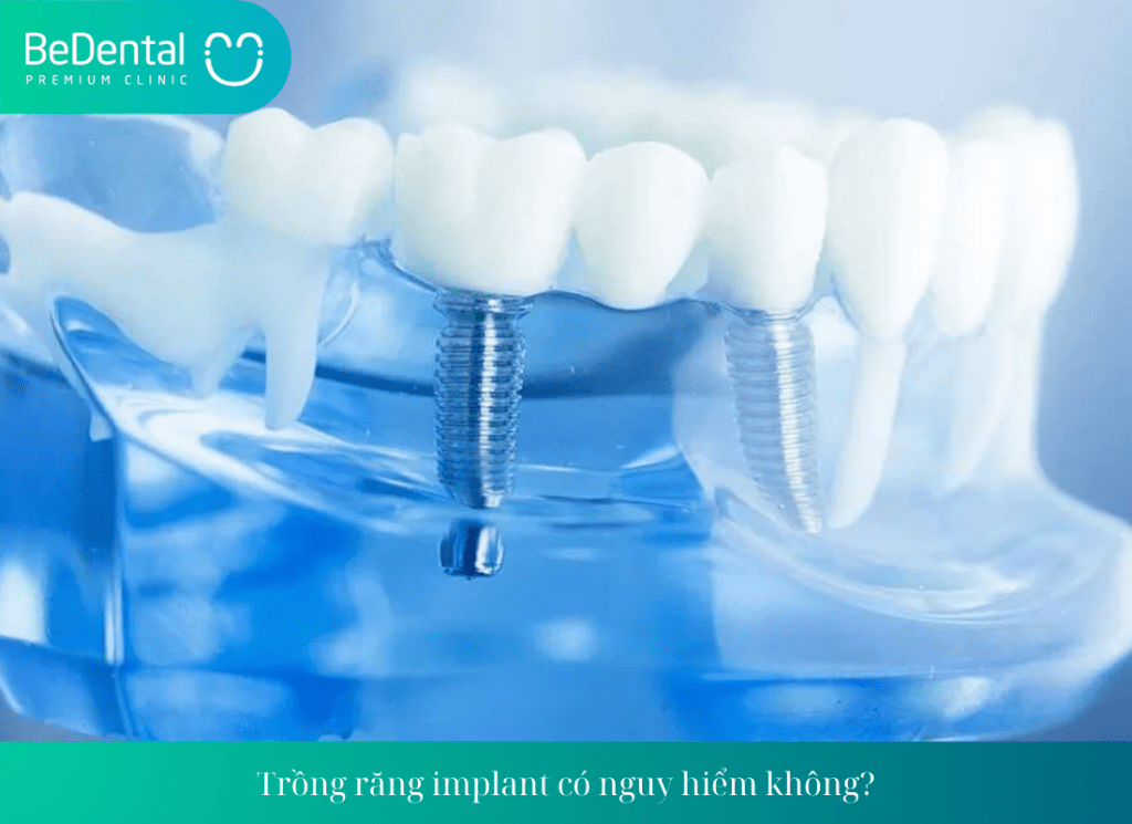 Những biến chứng khi trồng răng implant là gì?