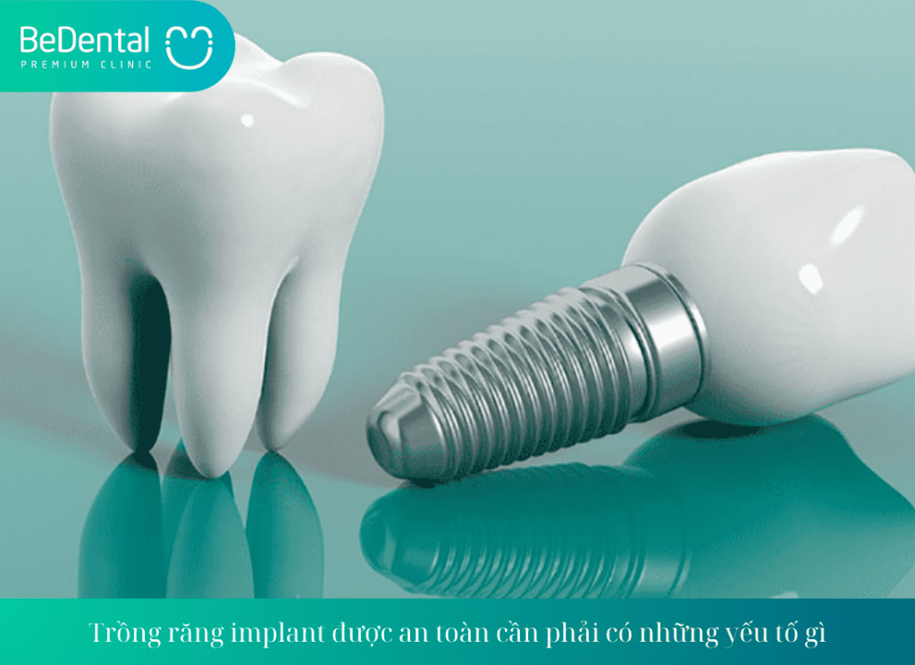 Trồng răng implant được an toàn cần phải có những yếu tố gì