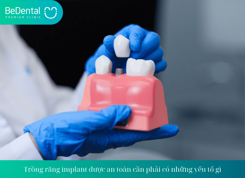 Trồng răng implant được an toàn cần phải có những yếu tố gì