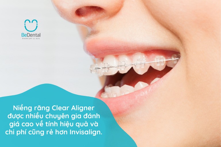 Niềng răng trong suốt Clear Aligner