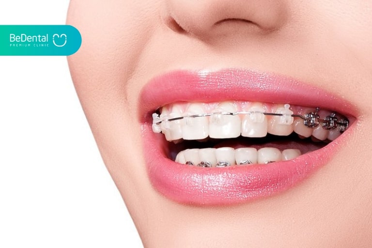Niềng răng giúp bạn khắc phục khuyết điểm răng hô, móm, khấp khểnh,...