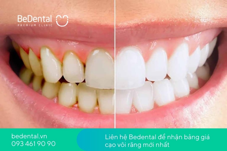 BeDental có dịch vụ cạo vôi răng chuyên sâu, giá hợp lý