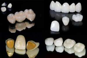 các loại răng sứ thường gặp