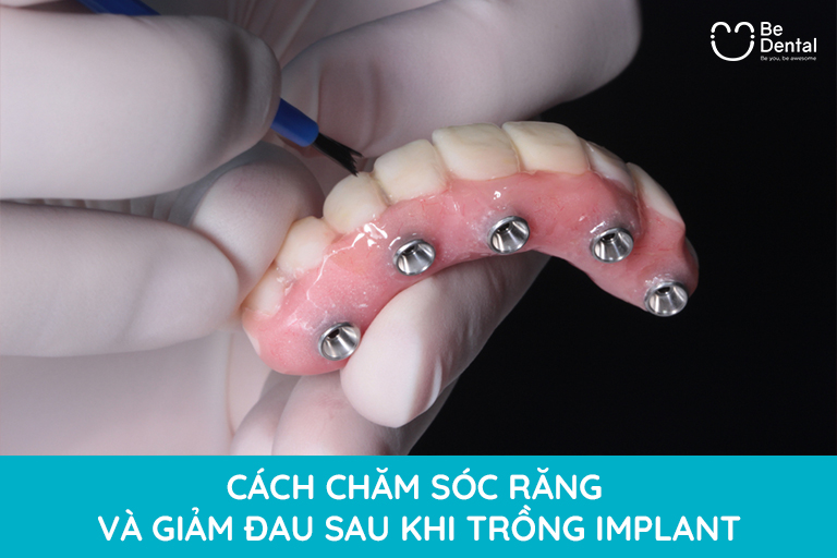 Cách chăm sóc trước và sau khi trồng răng implant