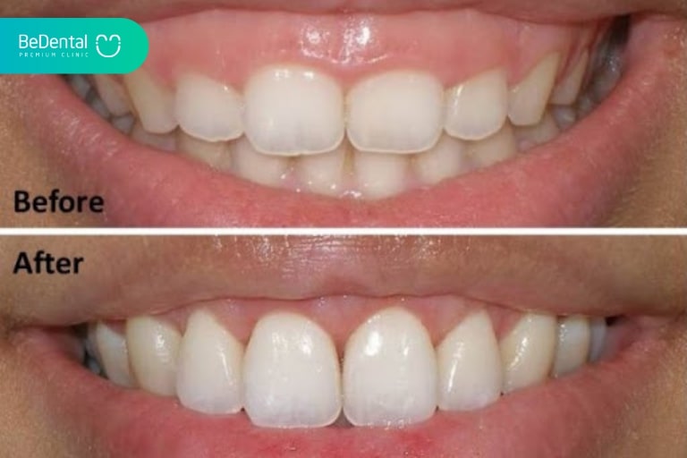 What is Gum Contouring and Cosmetic Gum Surgery?