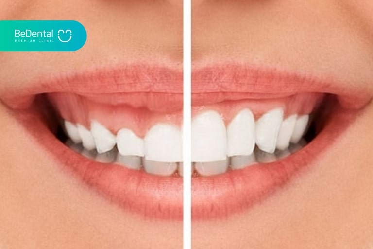 Gum Contouring and Cosmetic Gum Surgery