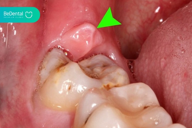 Lợi trùm được bao phủ trên bề mặt răng, dễ bị viêm nhiễm và gây sưng nhức