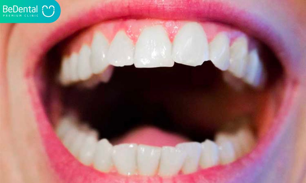 Nếu răng cửa bị gãy hoặc rụng trước khi thời điểm tự nhiên của răng bị rụng, các răng mới sẽ không mọc lên.