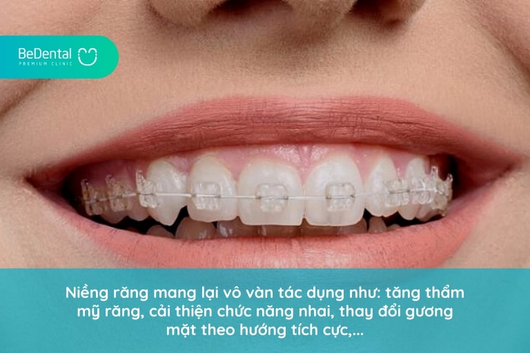 Niềng răng mang đến nhiều công dụng khác nhau, đặc biệt là thẩm mỹ toàn hàm
