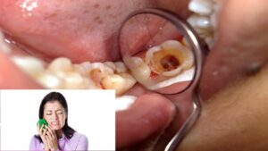 Bệnh lý thường gặp – Viêm tủy răng