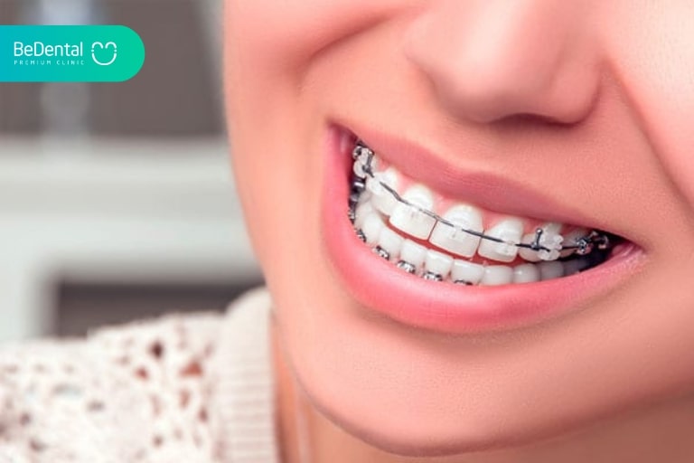 Niềng răng giúp mang lại hiệu quả thẩm mỹ hoàn hảo. Hiện tại, đây là phương pháp chỉnh nha tốt nhất. Nếu bạn muốn răng đẹp và đều thì nên tham khảo.