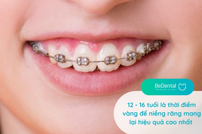 12 - 16 tuổi là độ tuổi niềng răng đẹp nhất và mang lại hiệu quả thẩm mỹ cao
