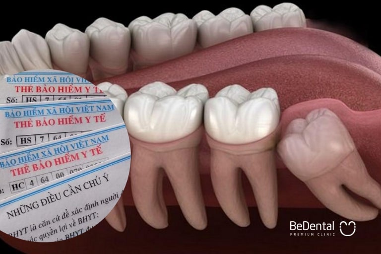 Nhổ răng được bảo hiểm y tế chi trả trong một số trường hợp nhất định
